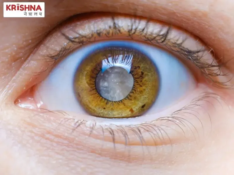A representational image for Cataract in Eye