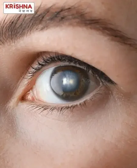 What is Cataract – Dr. Nikhil Govindwar Explains What is Cataract - Dr. Nikhil Govindwar Explains