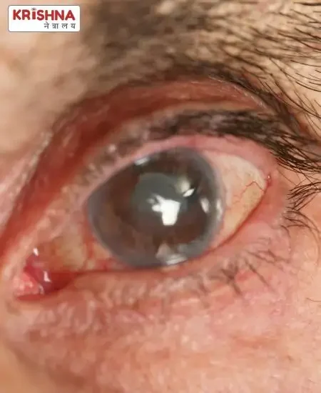 What is Glaucoma or Kach Bindu – Dr. Nikhil Govindwar Explains An old man's eye infected with glaucoma