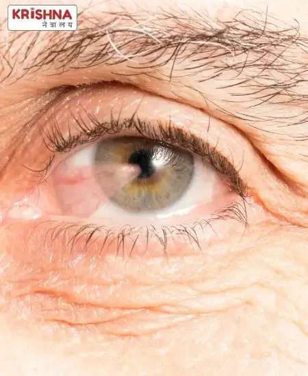 What is Pterygium Eye Disease – Explained by Dr. Nikhil Govindwar in Nanded An old man eye with Pterygium Eye Disease in Nanded